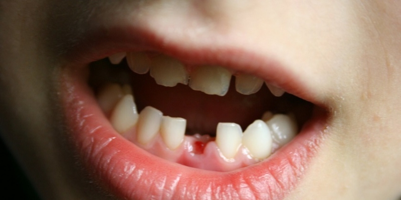 Nữ mơ thấy rụng răng