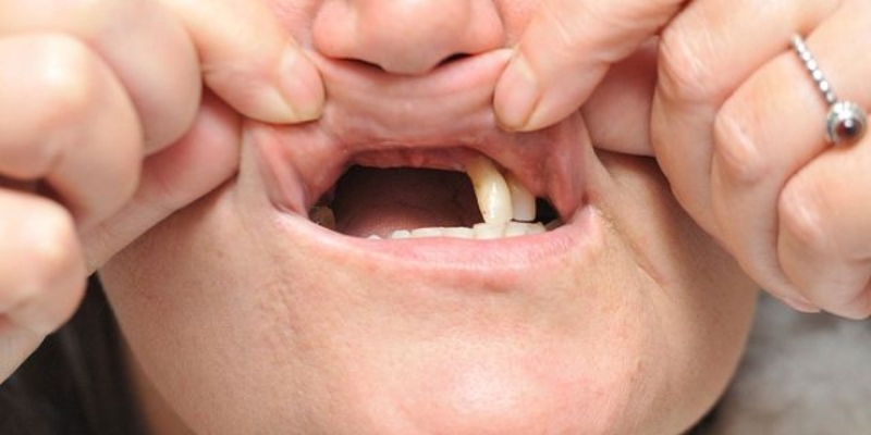 Nằm mơ thấy rụng ba cái răng